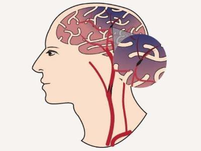 脑梗容易复发吗?复发前都有哪些征兆?